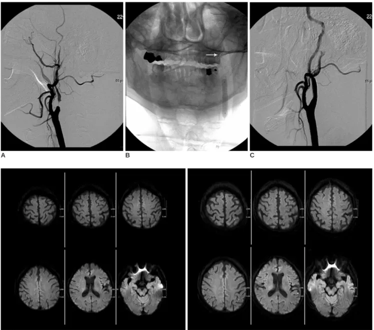 Fig. 2. A 71-year-old man who underwent protected carotid artery stenting with a filter device.