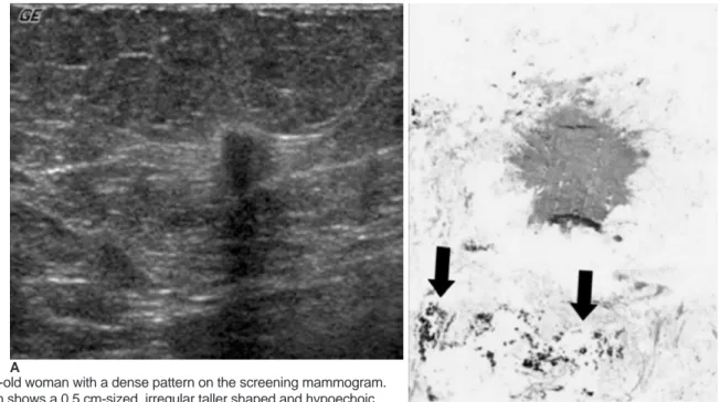 Fig. 1. A 67-year-old woman with a dense pattern on the screening mammogram.