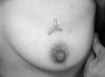 Fig. 3. Photograph of the left breast after breast conserving surgery demonstrates a residual charcoal stain along the scar