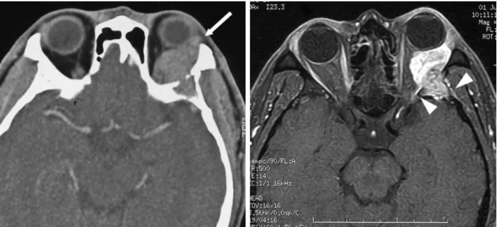 Fig. 5. A myoepithelial carcinoma in a 32-year-old man. 