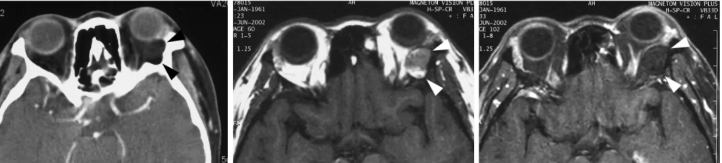 Fig. 11. An epidermoid cyst in a 35-year-old man. 