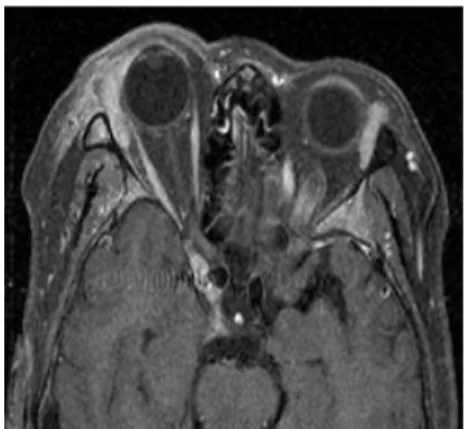 Fig. 13. A lipoma in a 64-year-old man. 