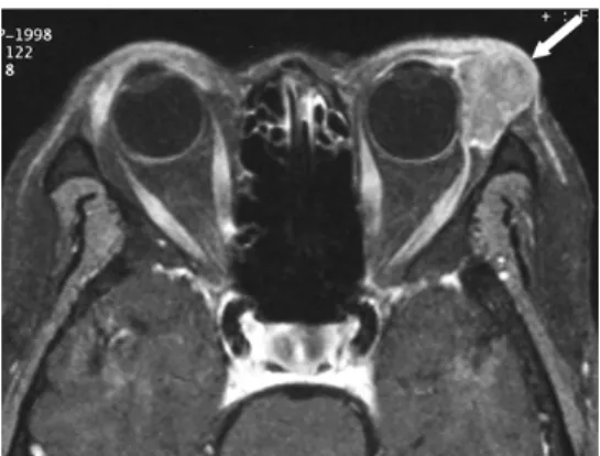 Fig. 17. Squamous cell carcinoma of the conjunctiva in an upper eyelid of a 61-year-old man.