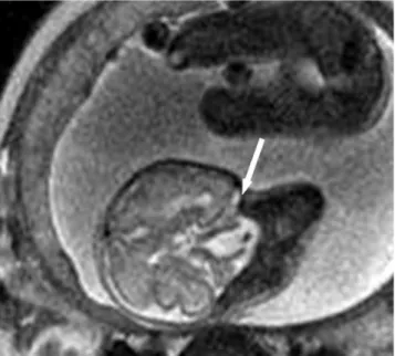 Fig. 8. MR image reveals a widened upper spinal canal (straight arrow) with a normal distal spine.