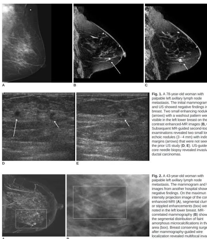 Fig. 1. A 78-year-old woman with palpable left axillary lymph node metastasis. The initial mammogram (A) and US showed negative findings in the breast