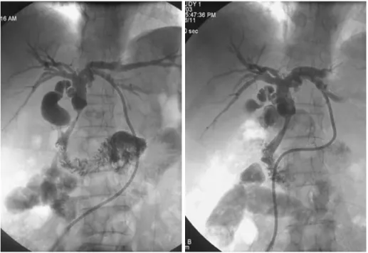 Fig 3. The graph shows the changes of the amylase and lipase level before and after stent placement and during the last  follow-up