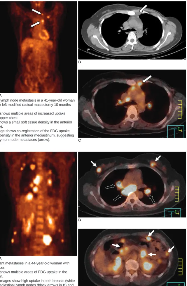 Fig. 4. Mediastinal lymph node metastasis in a 41-year-old woman who had undergone left modified radical mastectomy 10 months previously