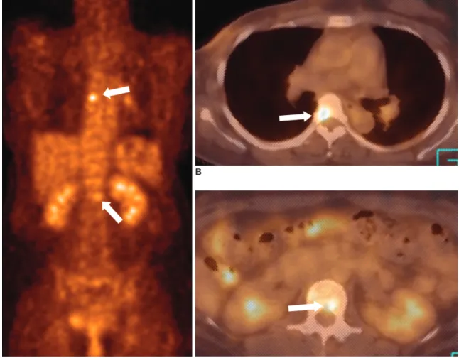 Fig. 6. Bone metastases in a 47-year-old woman with breast cancer. 