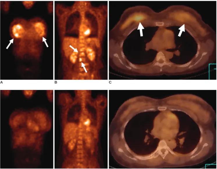 Fig. 8. Chemotherapy in a 35-year-old woman with bilateral breast cancer and bone metastases