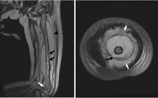 Fig. 2. MRI of the left thigh performed at the first hospital day. 