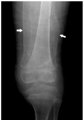 Fig. 4. The radiograph performed six weeks after vitamin C supplementation. Large shells of periosteal bone (arrows) are present at the left femur
