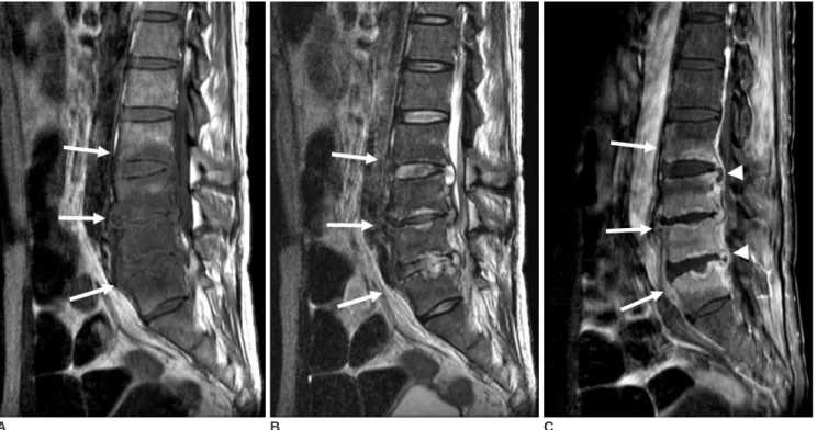 Fig. 1. A 46-year-old man with aspergillus spondylitis.