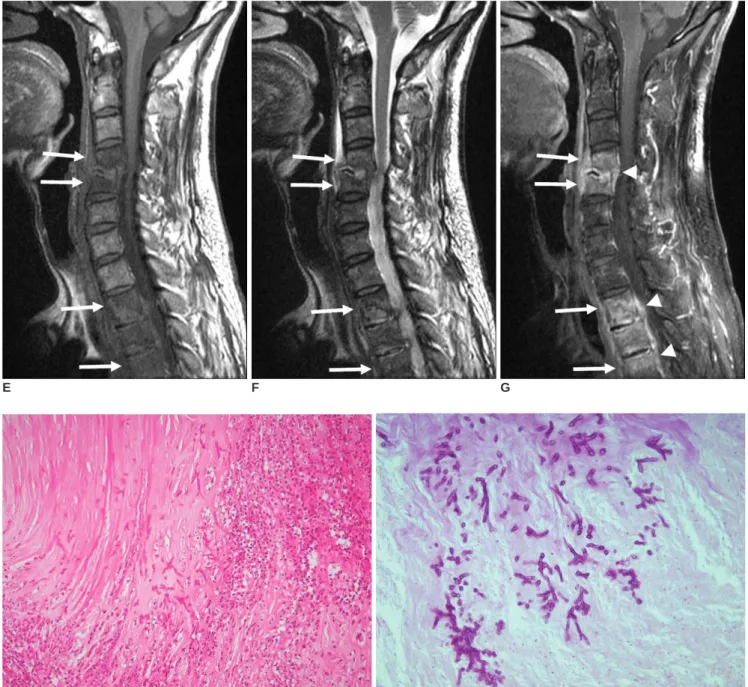 Fig. 1. E, F. MR image of cervical spine showing diffuse hypointense signals (arrows) in C4-5 and T2-4 vertebral bodies on T1-weighted images (E)