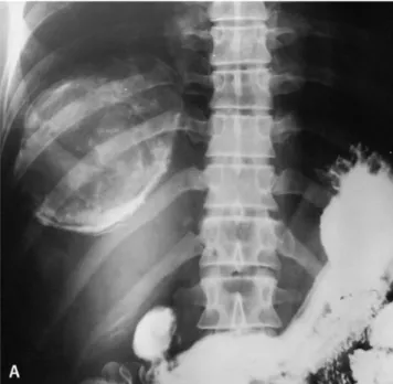 Fig. 1. Type I hydatid cyst of the liver in an 11-year-old girl. Un- Un-enhanced CT scan of the upper abdomen shows a large  unilocu-lar hydatid cyst (18 HU) with a high-attenuation wall in the subdiaphragmatic portion of the liver (arrow).