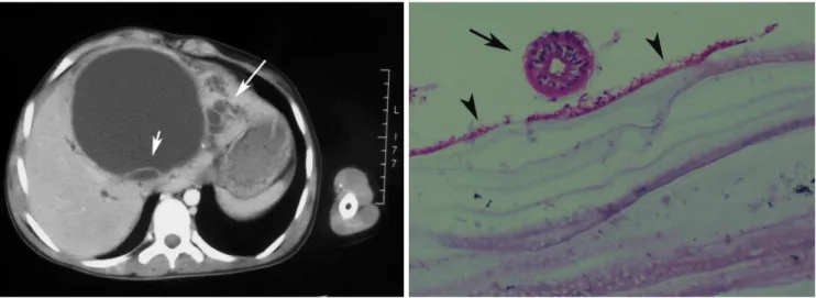 Fig. 7. A. Large type II hydatid cyst of the liver in a 12-year-old girl. Contrast-enhanced transverse CT scan of the upper abdomen demonstrates cystic lesion with a peripheral daughter cyst (short arrow)