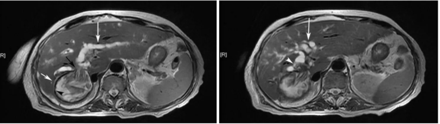 Fig. 10. Rupture of hydatid cyst into the biliary tree in a 54-year-old woman. 
