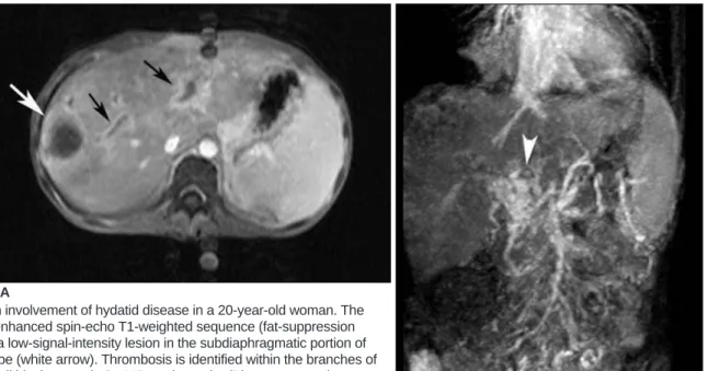 Fig. 11. Portal vein involvement of hydatid disease in a 20-year-old woman. The axial (A) contrast enhanced spin-echo T1-weighted sequence (fat-suppression technique) shows a low-signal-intensity lesion in the subdiaphragmatic portion of the right hepatic 