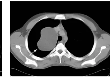 Fig. 23. A mediastinal hydatid disease in a 20-year-old man. The axial contrast-enhanced CT scan shows a well-defined,  low-attenuation lesion (arrow) that is consistent with type I unilocular hydatid cyst