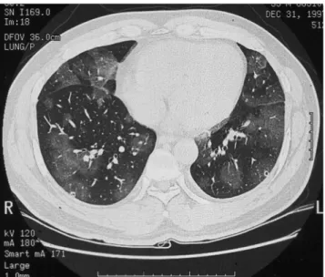 Fig. 1. Lung CT showing multifocal ground-glass opacities in both lungs, suggesting a pulmonary hemorrhage.