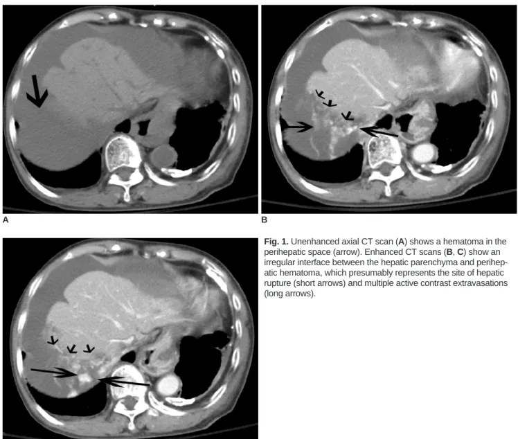 Fig. 1. Unenhanced axial CT scan (A) shows a hematoma in the perihepatic space (arrow)