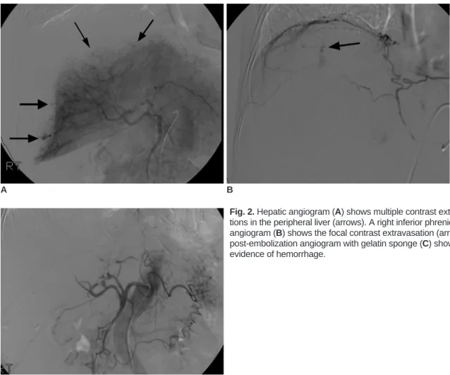 Fig. 2. Hepatic angiogram (A) shows multiple contrast extravasa- extravasa-tions in the peripheral liver (arrows)