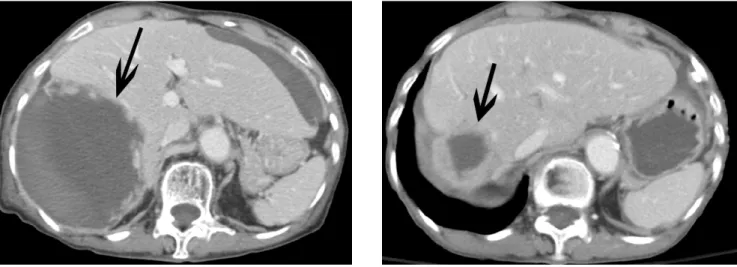 Fig. 3. A follow-up enhanced CT scan after embolization two weeks later shows a large post-hemorrhagic pseudocyst formation (arrow)