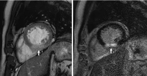 Fig. 1. Both the contrast-enhanced cine (A) and delayed contrast-enhanced (B) MR images in a 71-year-old male who had a history of chest pain for three days