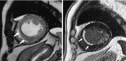 Fig. 3. The MR scan obtained in a 62- 62-year-old male who was scheduled for coronary bypass surgery