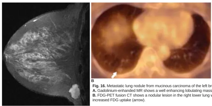 Fig. 16. Metastatic lung nodule from mucinous carcinoma of the left breast.