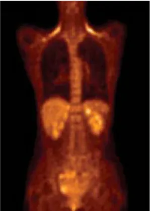 Fig. 2. Normal increased FDG uptake in the shoulder area which represents brown fat.