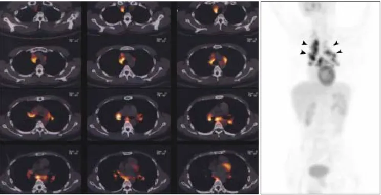 Fig. 4. Tuberculous lymphadenitis in a 56-year-old male. 
