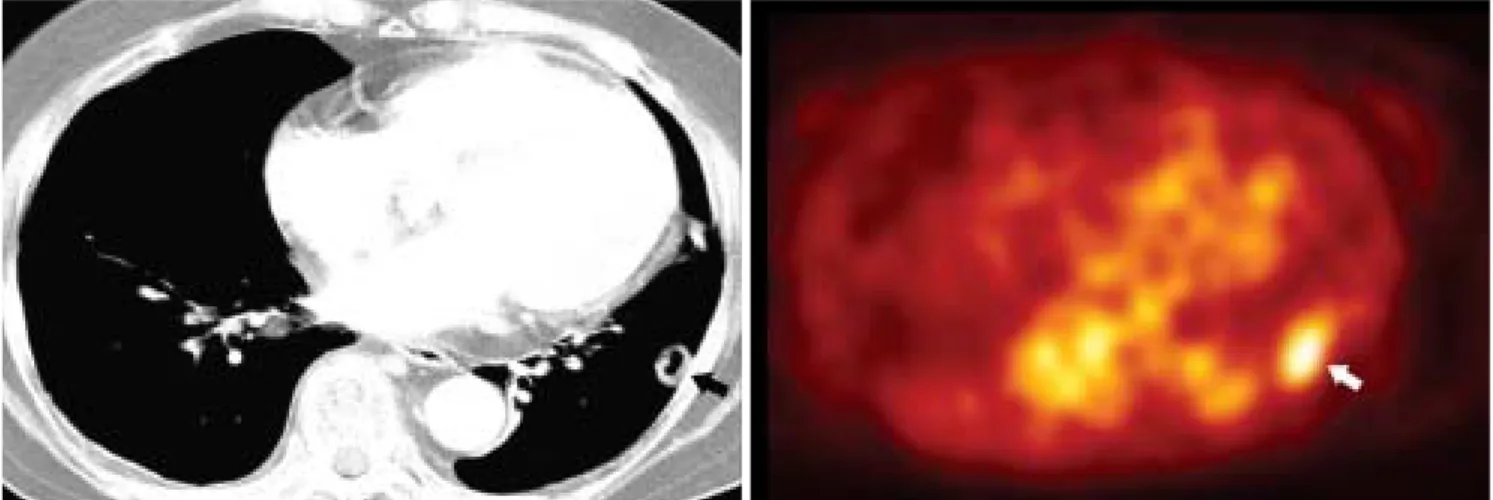 Fig. 6. Cryptococcosis in a 68-year-old female.