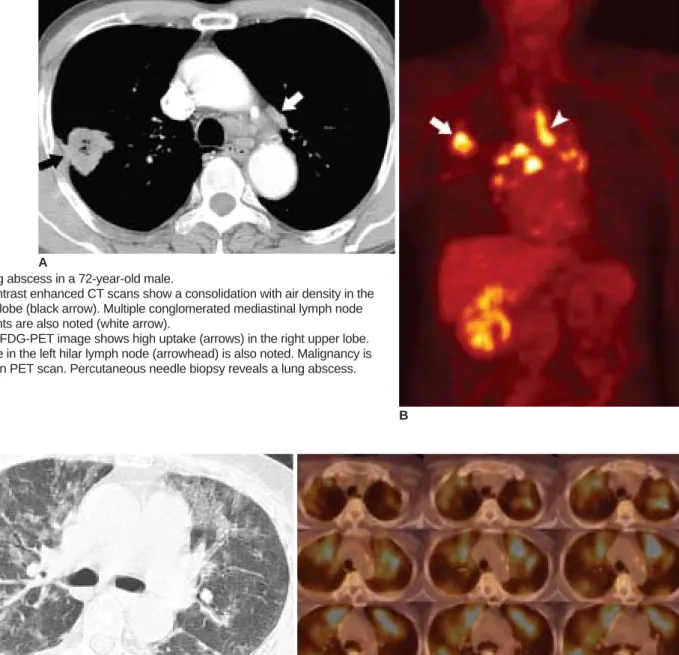 Fig. 8. Lung abscess in a 72-year-old male.