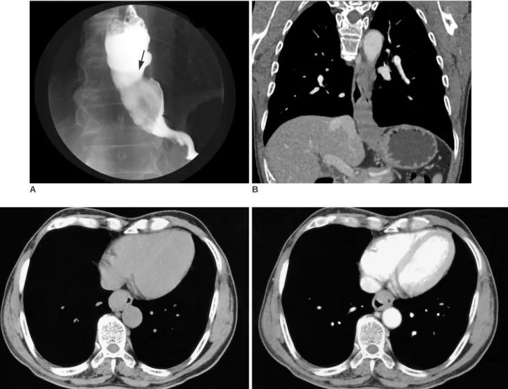 Fig. 1. A 62-year-old man with esophageal Castleman disease.