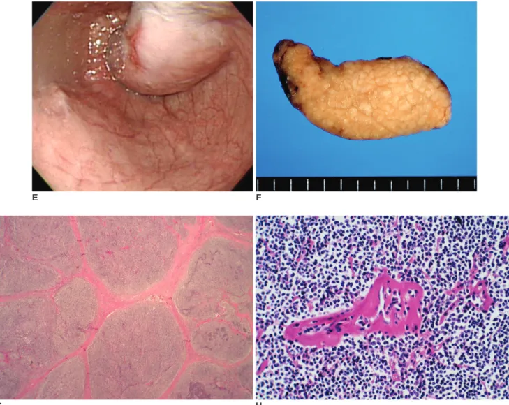 Fig. 1. E. Endoscopy reveals a smoothly bulging mass with smooth surface and focal reddish coloration on the distal esophagus.