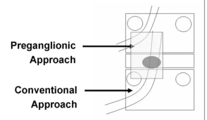 Fig. 1. Schematic description for transforaminal epidural steroid injection with the preganglionic approach versus the conventional approach.