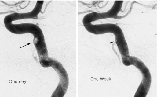 Fig. 3. On the serial follow-up angiograms done at one day and one week after the initial procedure,  progres-sive resolution of the blood clot (arrow) is seen