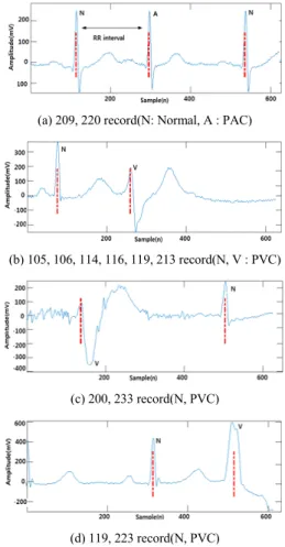 Fig.  3  Variability  of  RR  interval  by  each  arrhythmia