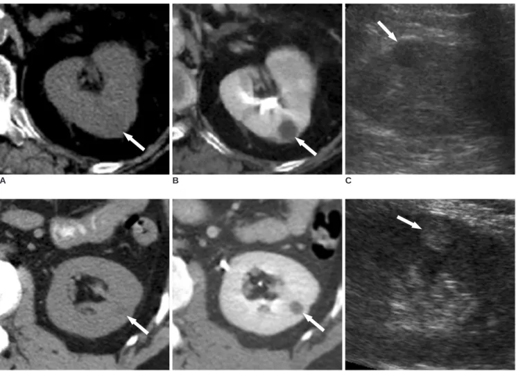 Fig. 1. Representative cases showing the importance of falsely increased attenuation in small renal cysts in the nephrographic phase of MDCT