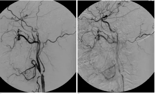 Fig. 4. After carotid artery stenting, a well deployed carotid stent was seen at the left proximal internal carotid artery and the distal common carotid artery on digital subtraction angiography.