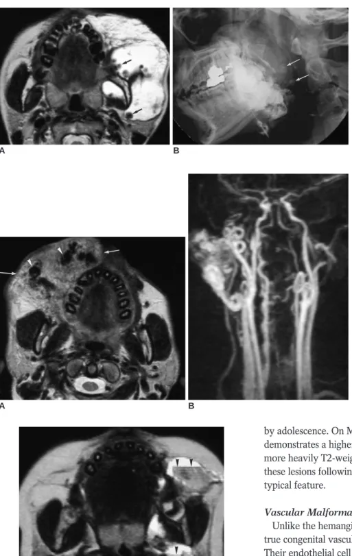 Fig. 6. Arteriovenous malformation in a 32-year-old man.