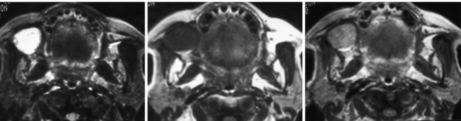 Fig. 9. Pleomorphic adenoma in a 65-year-old woman.
