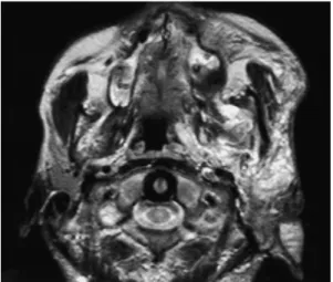 Fig. 13. Plexiform neurofibroma in a 20-year-old man.
