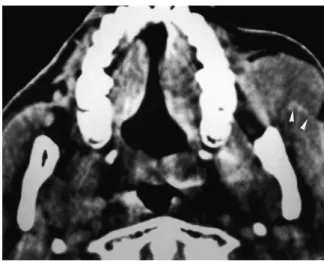 Fig. 15. Peripheral T-cell lymphoma in a 57-year-old woman.