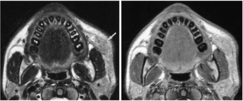 Fig. 18. Kimura disease in a 14-year-old boy.