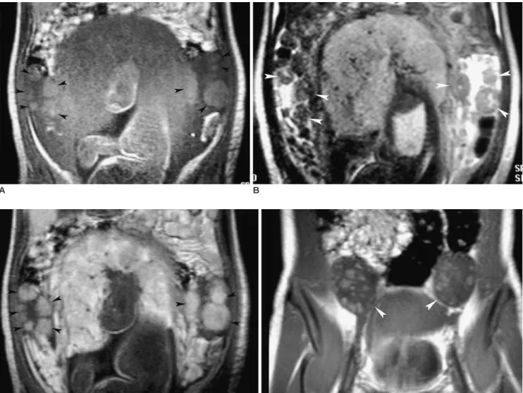 Fig. 1. Pregnancy luteoma. The peripheral-located multinodular ovarian masses (arrowheads) show intermediate high signal intensity on the coronal T1-weighted image (A, 101/4/1 [repetition time/echo time/excitation]), low signal intensity on the T2-weighted
