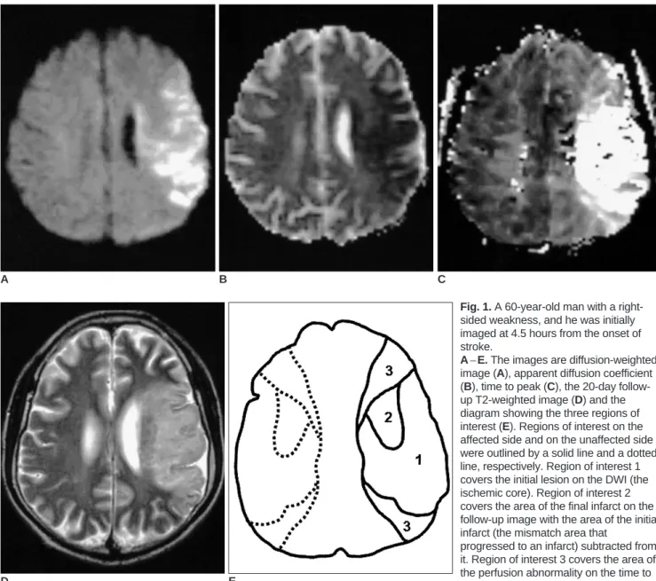 Fig. 1. A 60-year-old man with a right- right-sided weakness, and he was initially imaged at 4.5 hours from the onset of stroke.