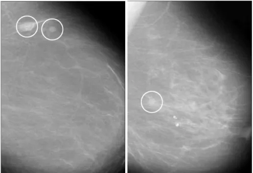 Fig. 1. A. Mammogram with a circum- circum-scribed mass.