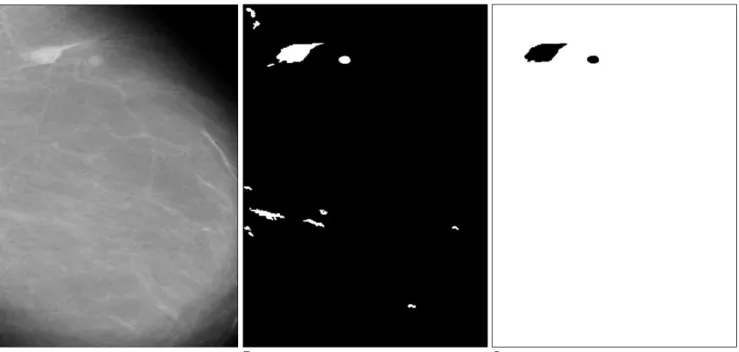 Fig. 7. A. The mammogram with a circumscribed mass.