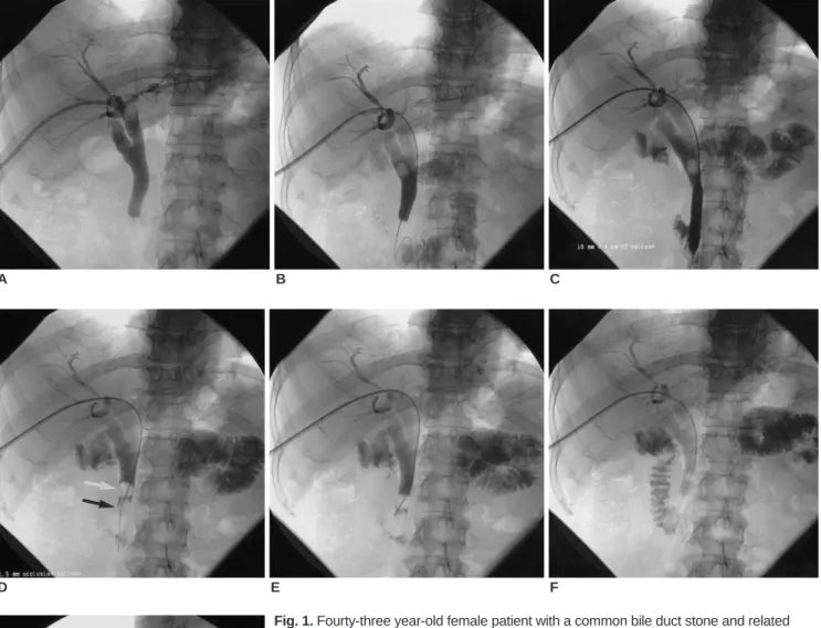 Fig. 1. Fourty-three year-old female patient with a common bile duct stone and related right upper quadrant pain